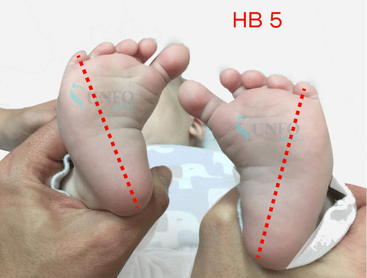 Деформация стопы у новорожденных