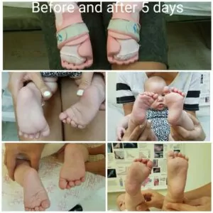 Severe case of Metatarsus Adductus, before and after 14 days