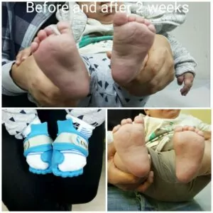 Mild case of Metatarsus Adductus, before and after 11 days