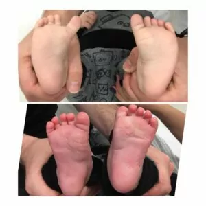 Moderate case of Metatarsus Adductus , before and after 12 days